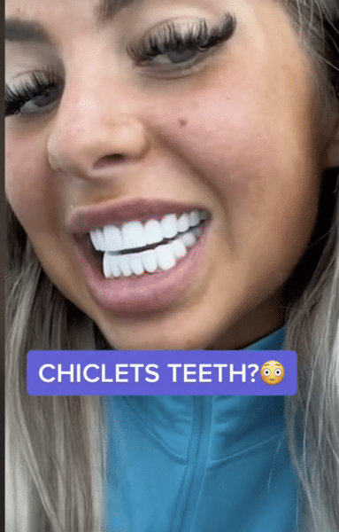 chiclet teeth reference image